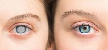 Glaucoma | Image credit: Alessandro Grandini - stock.adobe.com