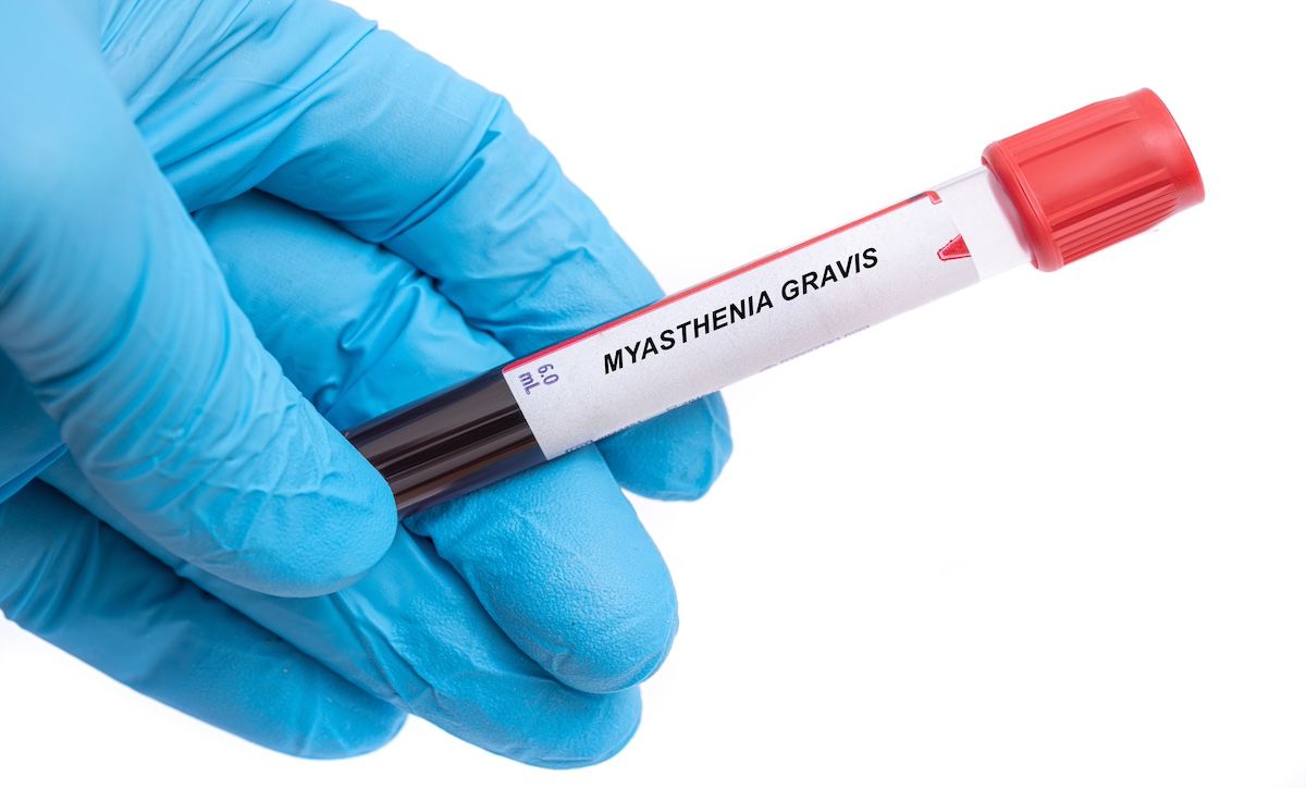 myasthenia gravis | Image Credit: luchschenF - stock.adobe.com