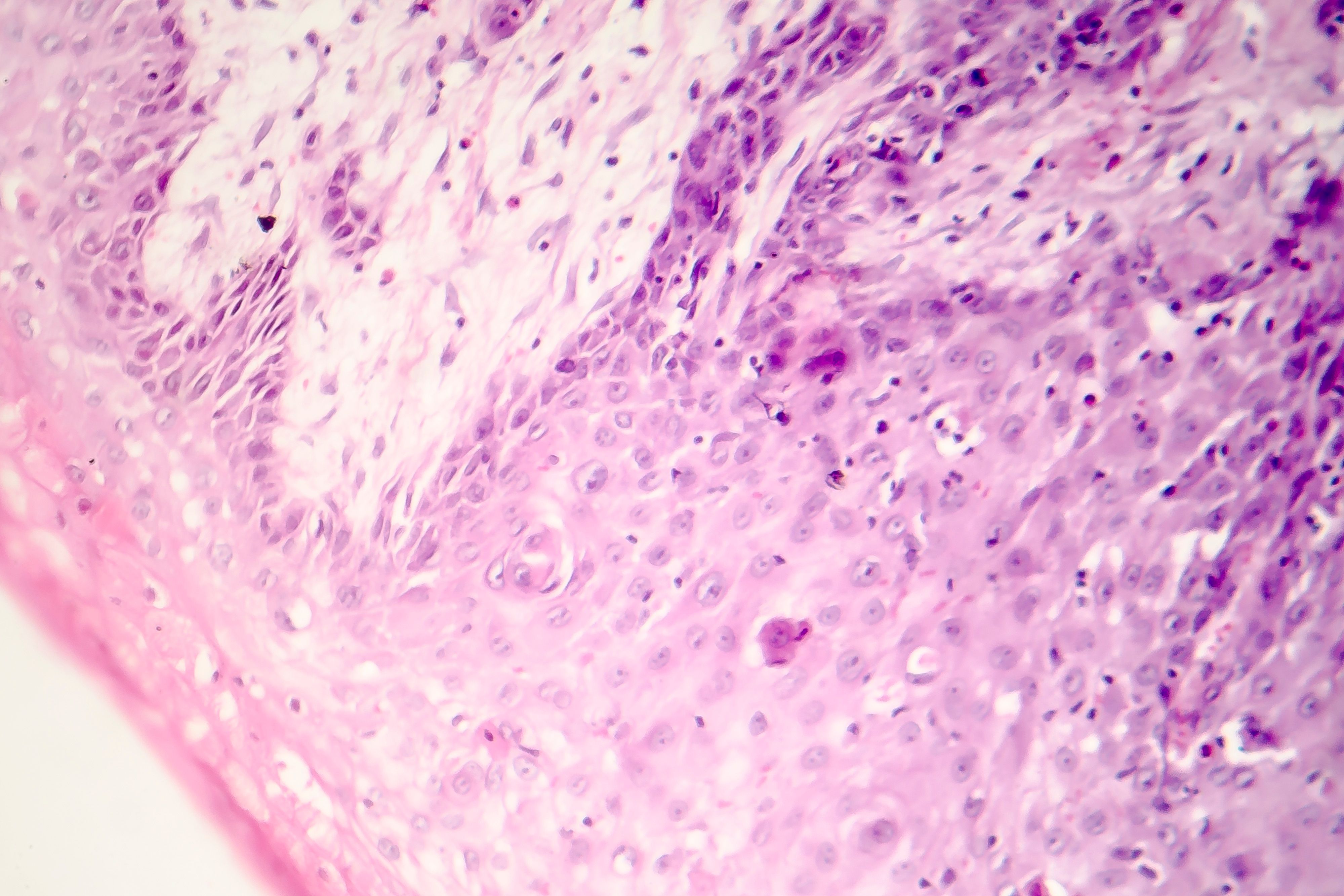 CSCC | Image Credit: Dr_Microbe - stock.adobe.com