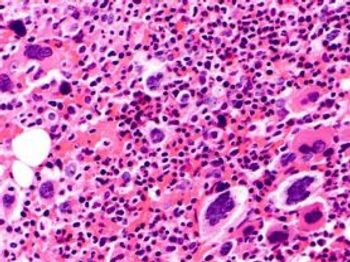Bone marrow from patient with PMF 