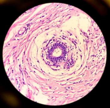 Hidradenitis suppurativa. | Image Credit: MdBabul - stock.adobe.com