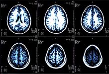 Celgene Resubmits Multiple Sclerosis Drug NDA for FDA Approval