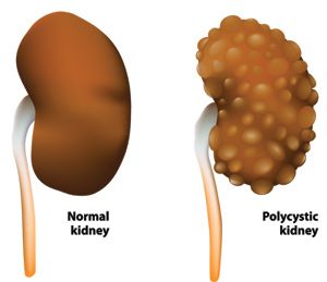 FDA Grants Orphan Drug Status to Regulus Therapeutics' Treatment for Common Type of PKD