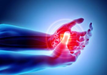 Rheumatoid arthritis in hand | Image credit: yodiyim – stock.adobe.com