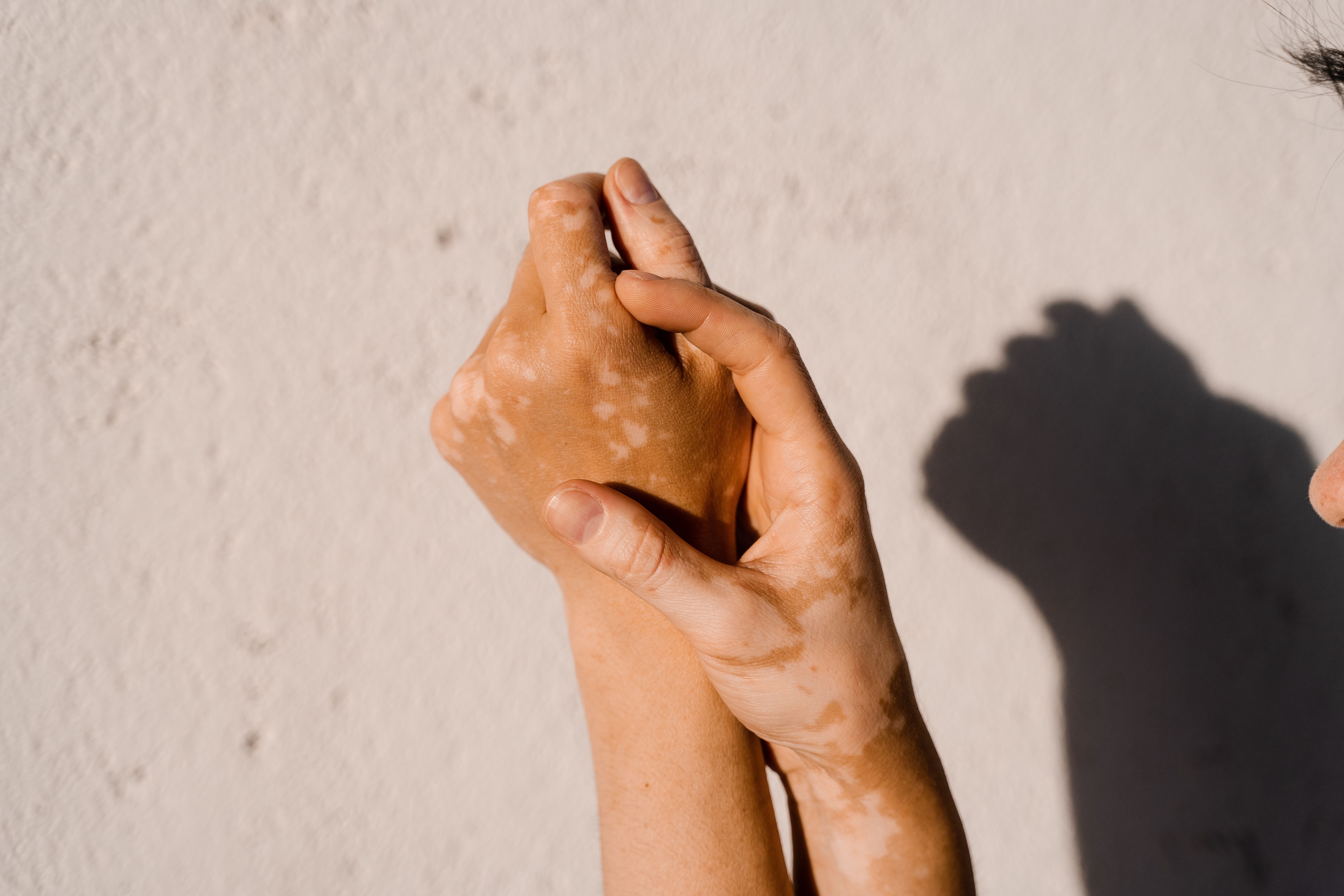 Uptake of Vitiligo Treatment Low in the First Year After Diagnosis - AJMC.com Managed Markets Network