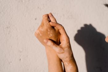 Vitiligo skin pigmentation on the hands of woman | Image Credit: Rabizo Anatolii - stock.adobe.com