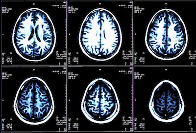 Stem Cell Transplant Effective Therapy in Patients With RRMS