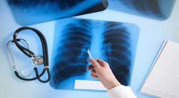 Image of an oncologist pointing out lung cancer