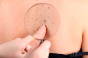 Meta-Analysis Finds Dupilumab Has Most Evidence of Effectiveness for Treating Atopic Dermatitis