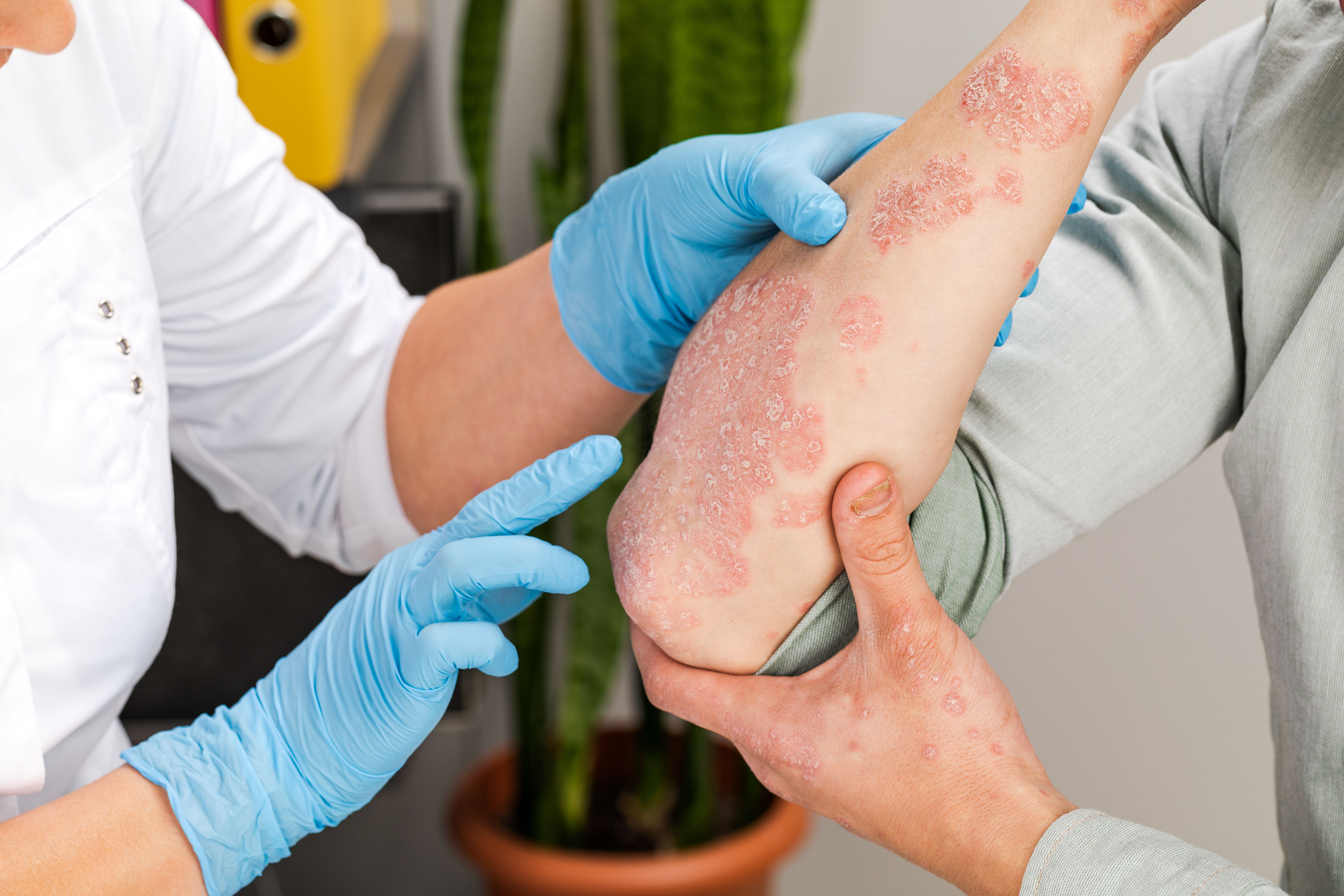 A dermatologist wearing gloves examines the skin of a sick patient. Examination and diagnosis of skin diseases-allergies, psoriasis, eczema, dermatitis | Image credit: © fusssergei - stock.adobe.com
