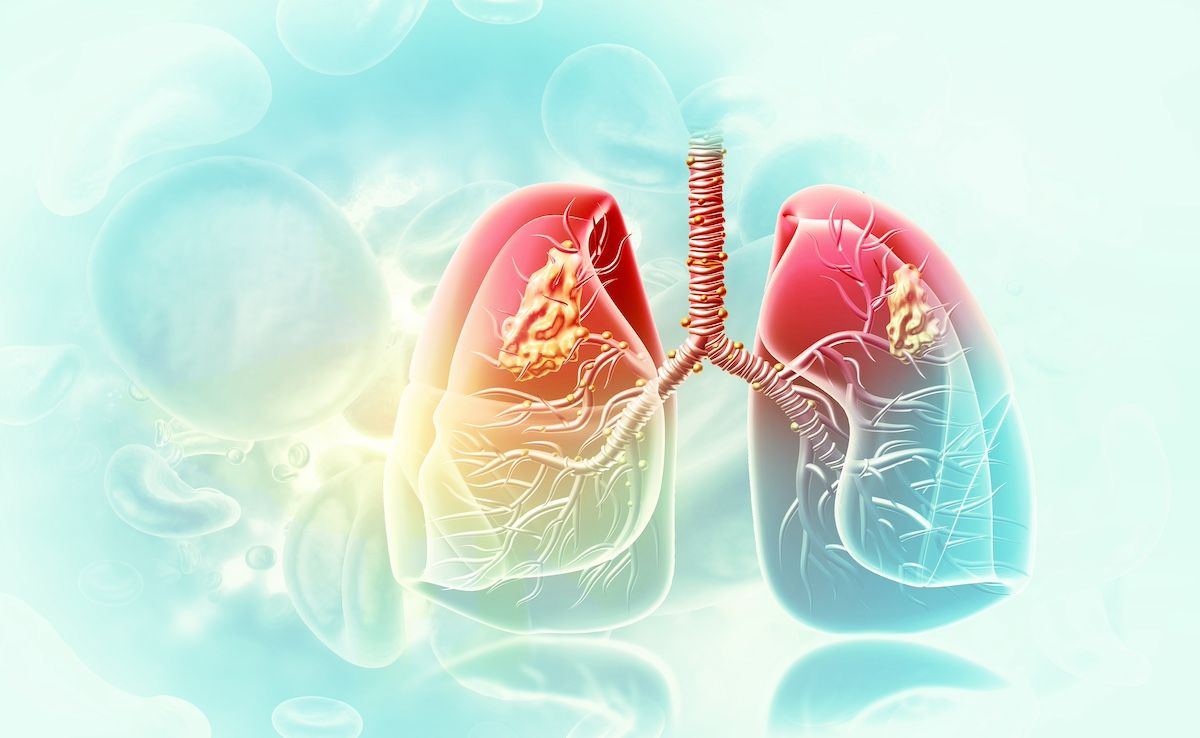 While elevated NLR previously served as a marker of aggressive disease and poor prognosis in SCLC, its prognostic relevance appears to diminish in the context of immunotherapy-based treatment regimens. | Image credit: Crystal light - stock.adobe.com