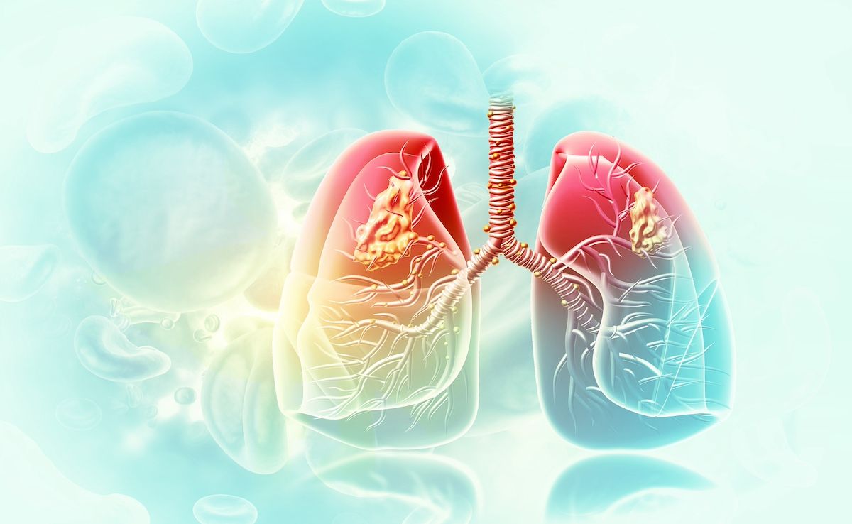 Lung cancer | Image Credit: © Crystal light - stock.adobe.com