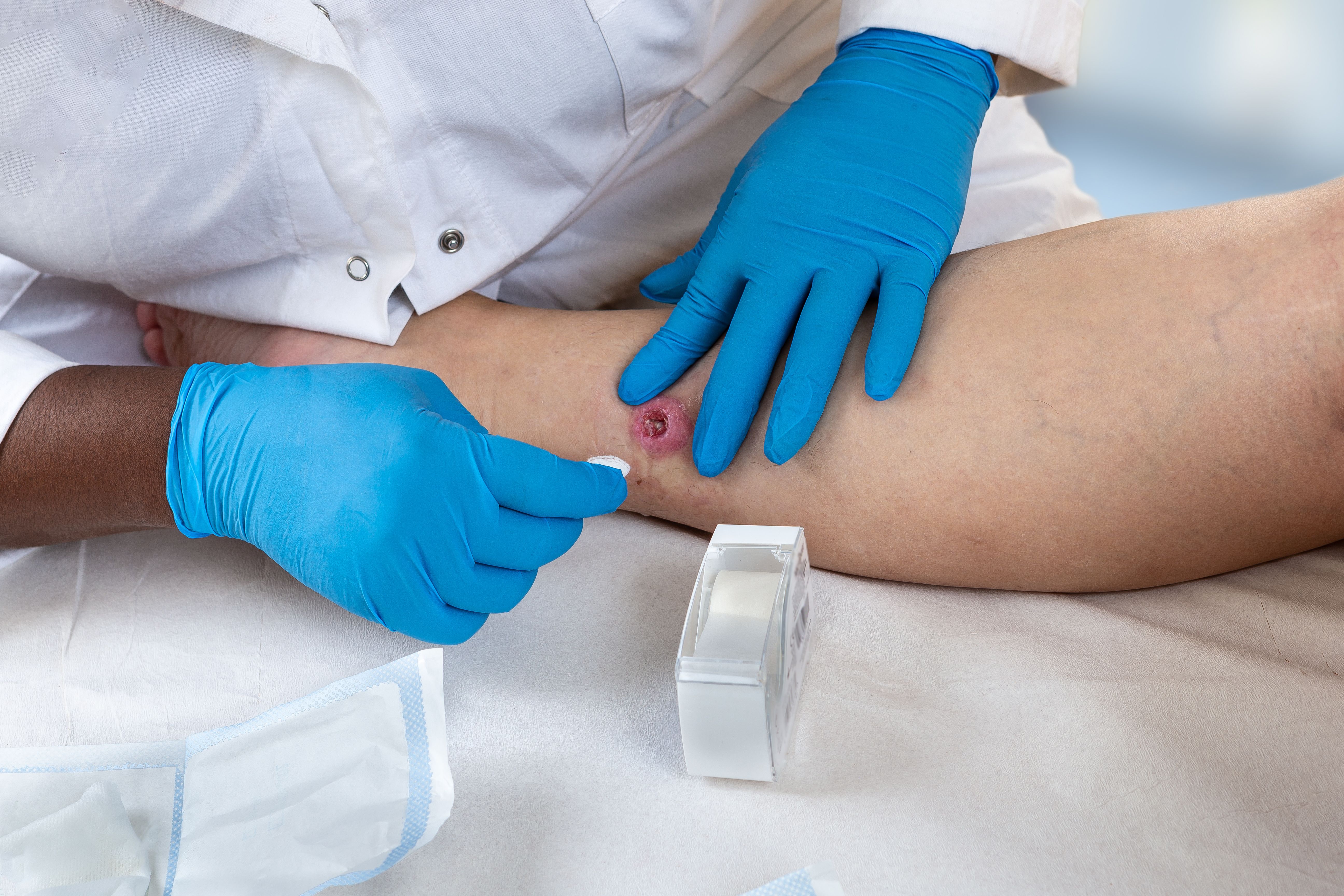 Hidradenitis suppurativa. | Image Credit: JPC-PROD - stock.adobe.com