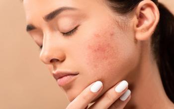 young woman with closed eyes touching face with acne isolated on beige: © LIGHTFIELD STUDIOS - stock.adobe.com