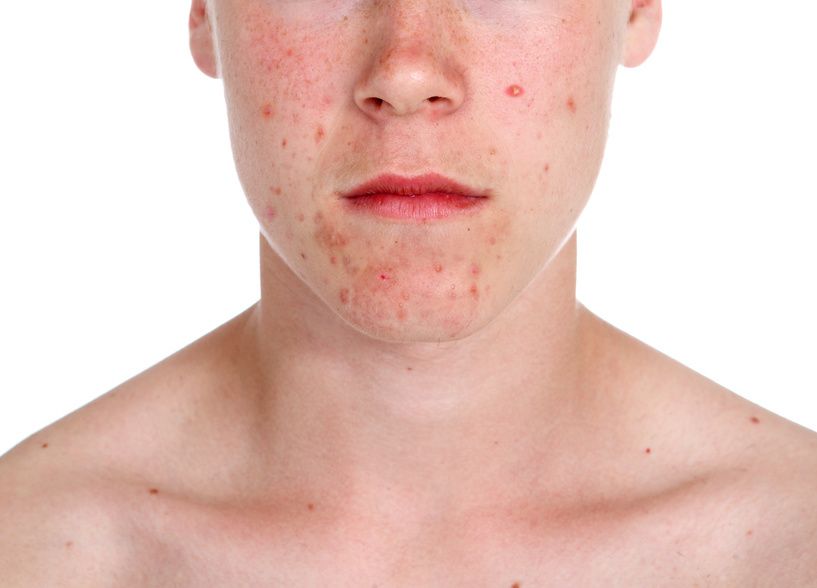 Image of teenager with acne