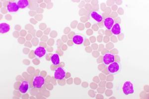 Rates of treatment-limiting adverse events and cardiac adverse events were lower on zanubrutinib vs ibrutinib. | Image credit: jarun011 - stock.adobe.com