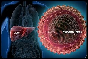 Perinatal Exposure to HCV Leads to Earlier Cirrhosis