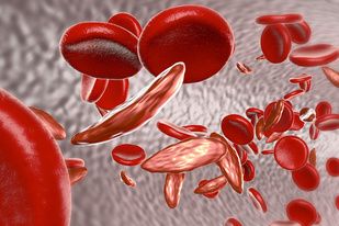 NIH Seeks 'Self' Cure in Patients With Sickle Cell Disease