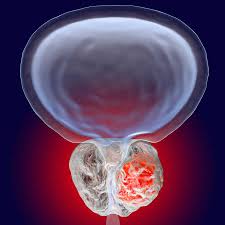 prostate cancer | Image: Dr Microbe Adobe