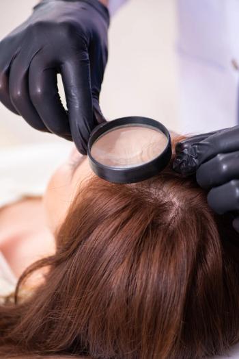 Doctor using magnifying glass to view scalp regrowth | Image Credit: Elnur - stock.adobe.com