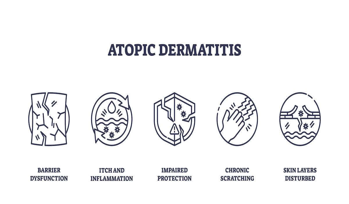 Atopic dermatitis  | Image Credit: © VectorMine-stock.adobe.com.