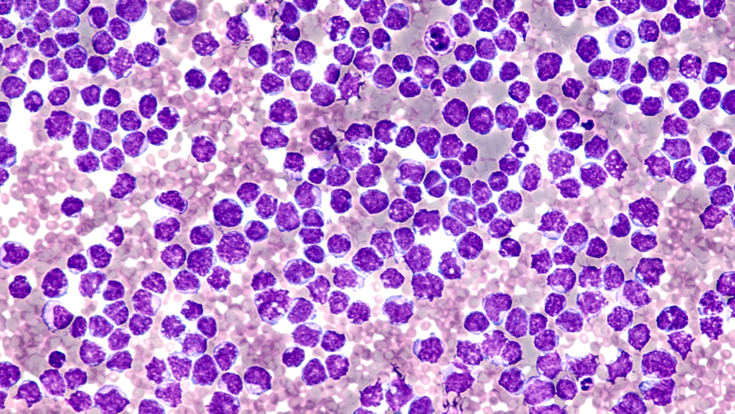 Pleural fluid cytology showing involvement by malignant cells of a mantle cell lymphoma, pleomorphic variant. | Image: David Litman for AdobeStock