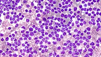 Pleural fluid cytology showing involvement by malignant cells of a mantle cell lymphoma, pleomorphic variant. | Image: David Litman for AdobeStock