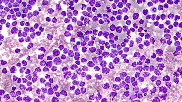 Pleural fluid cytology showing involvement by malignant cells of a mantle cell lymphoma, pleomorphic variant. | Image: David Litman for AdobeStock