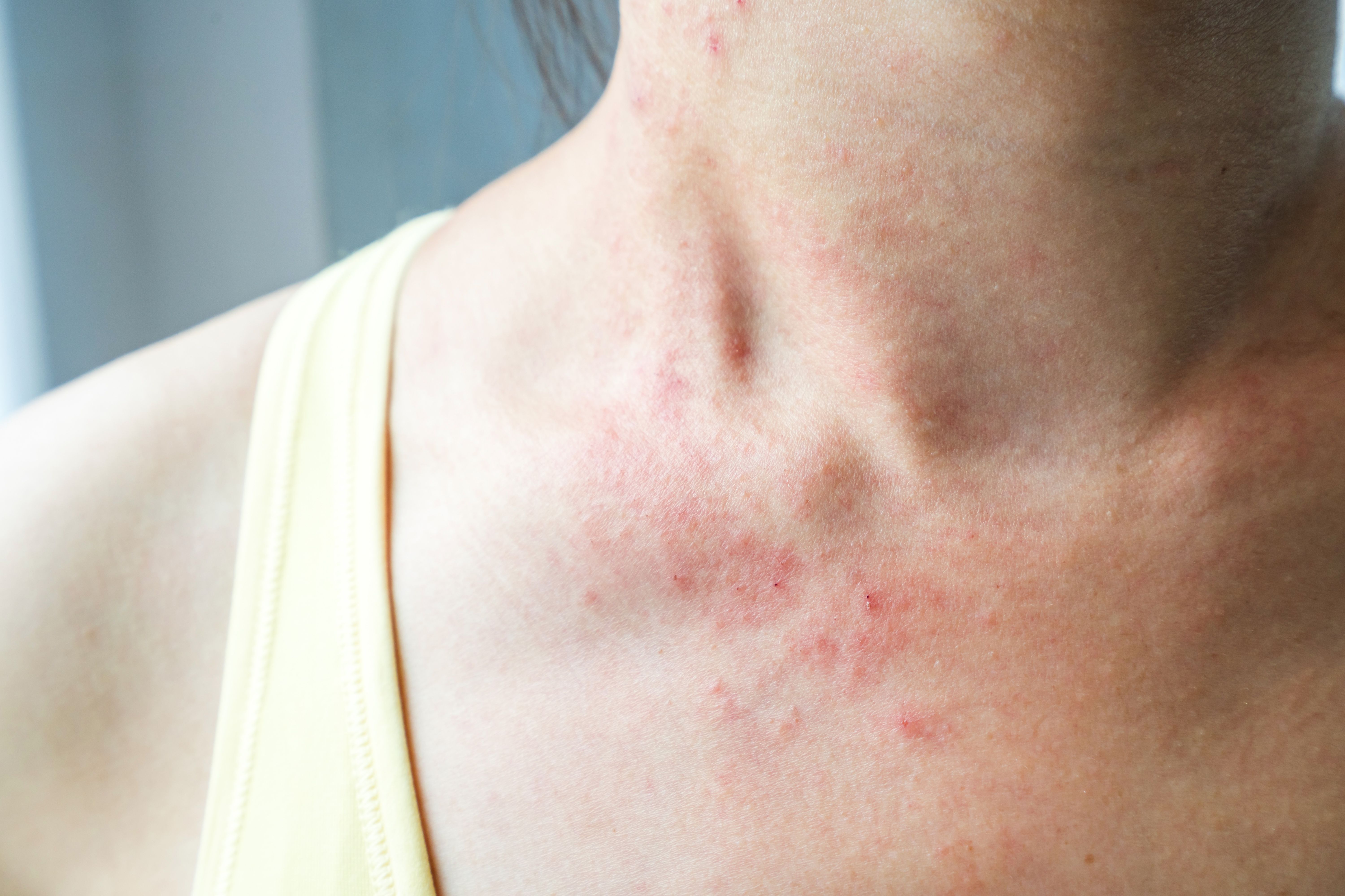 Researchers Identify Potential Predictors of Rash During AML Induction ...