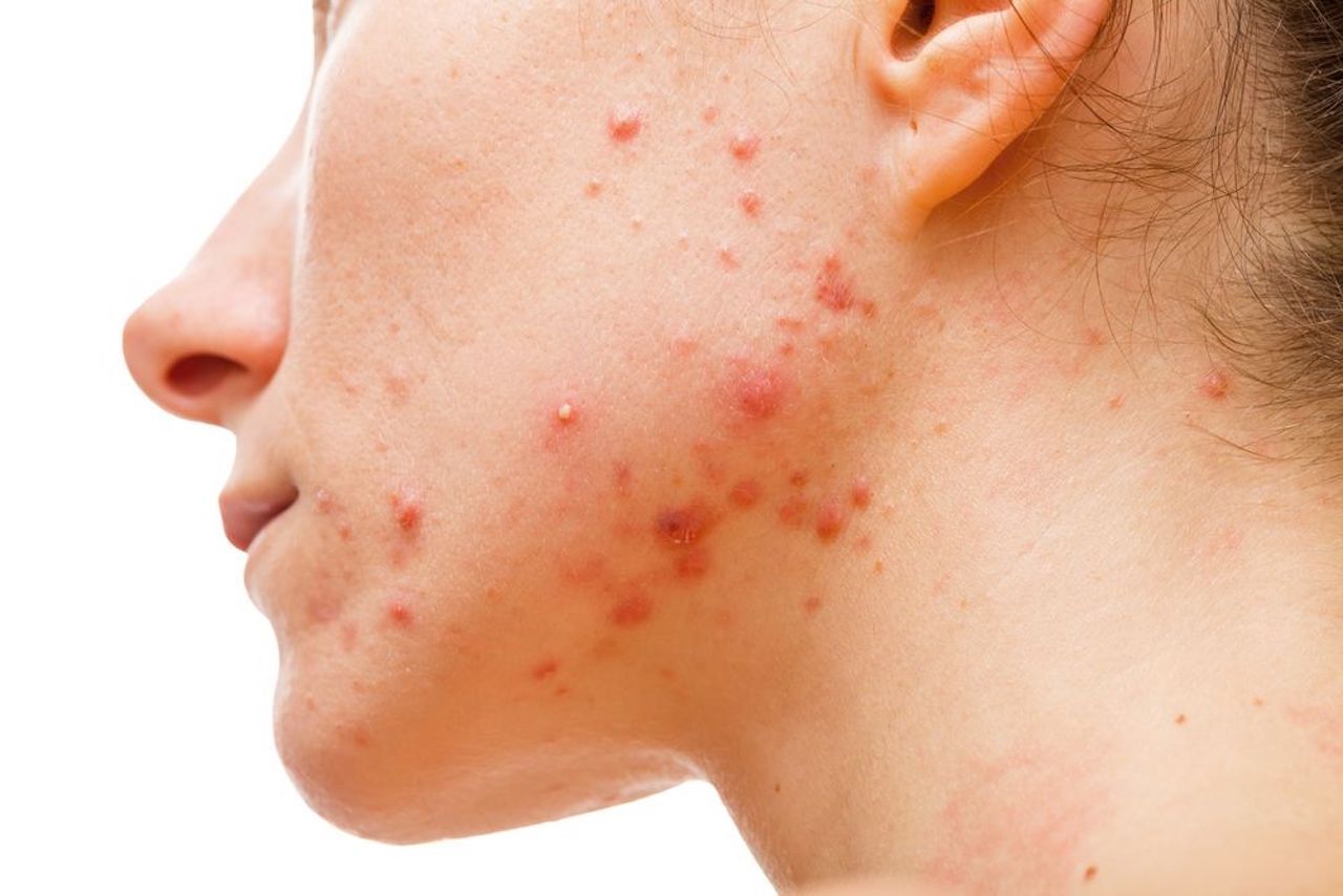 Acne skin: © Ocskay Bence - stock.adobe.com