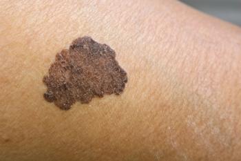 Melanoma | Image Credit: Octopus16 - stock.adobe.com