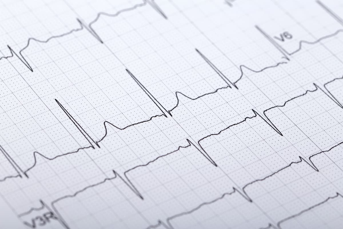 Despite the AI-ECG model’s potential, the authors cautioned it must be evaluated in a structured clinical framework to ensure that it improves established monitoring methods rather than replaces them. | Image credit: Yan - stock.adobe.com