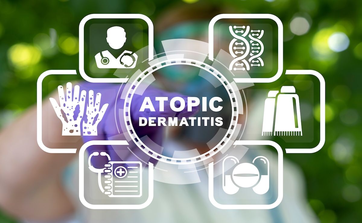 atopic dermatitis | Image Credit: © wladimir1804-stock.adobe.com