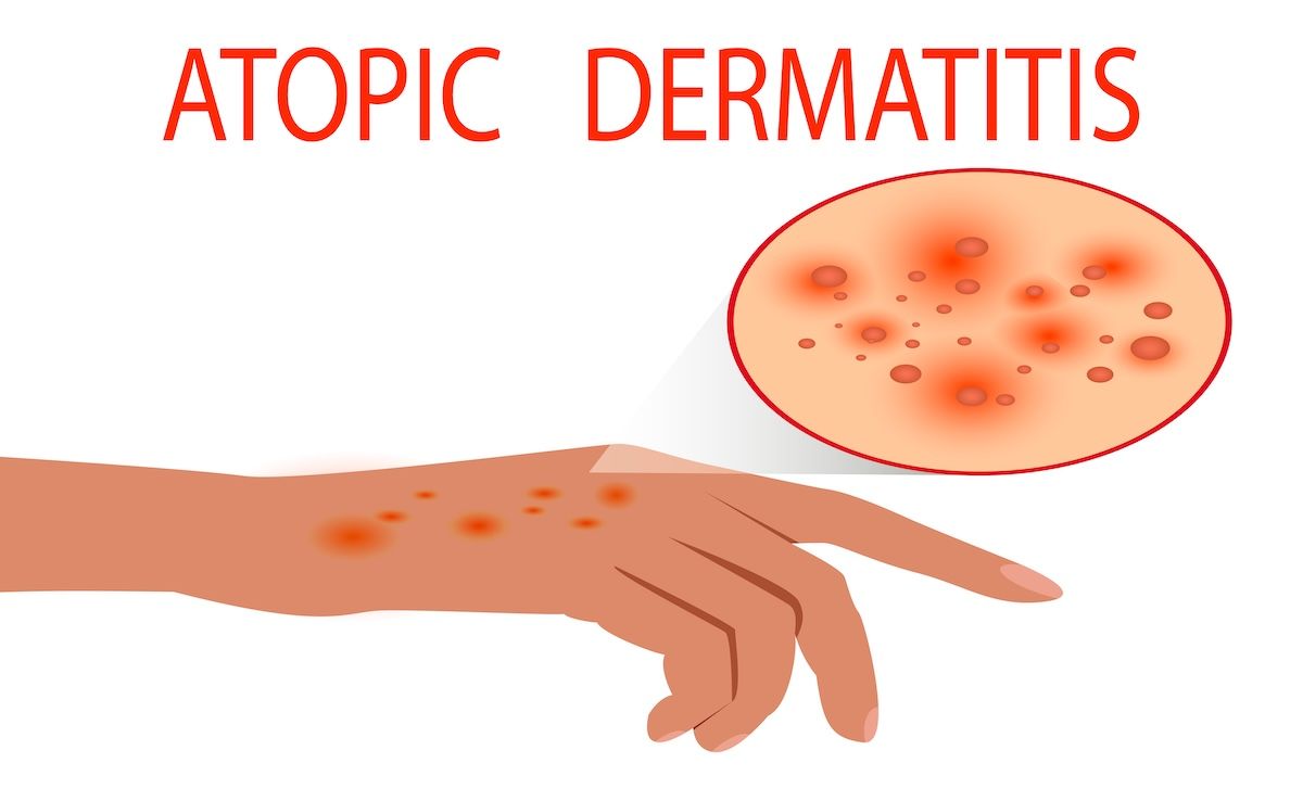 Atopic dermatitis | Image Credit: © slobodyan_78-stock.adobe.com