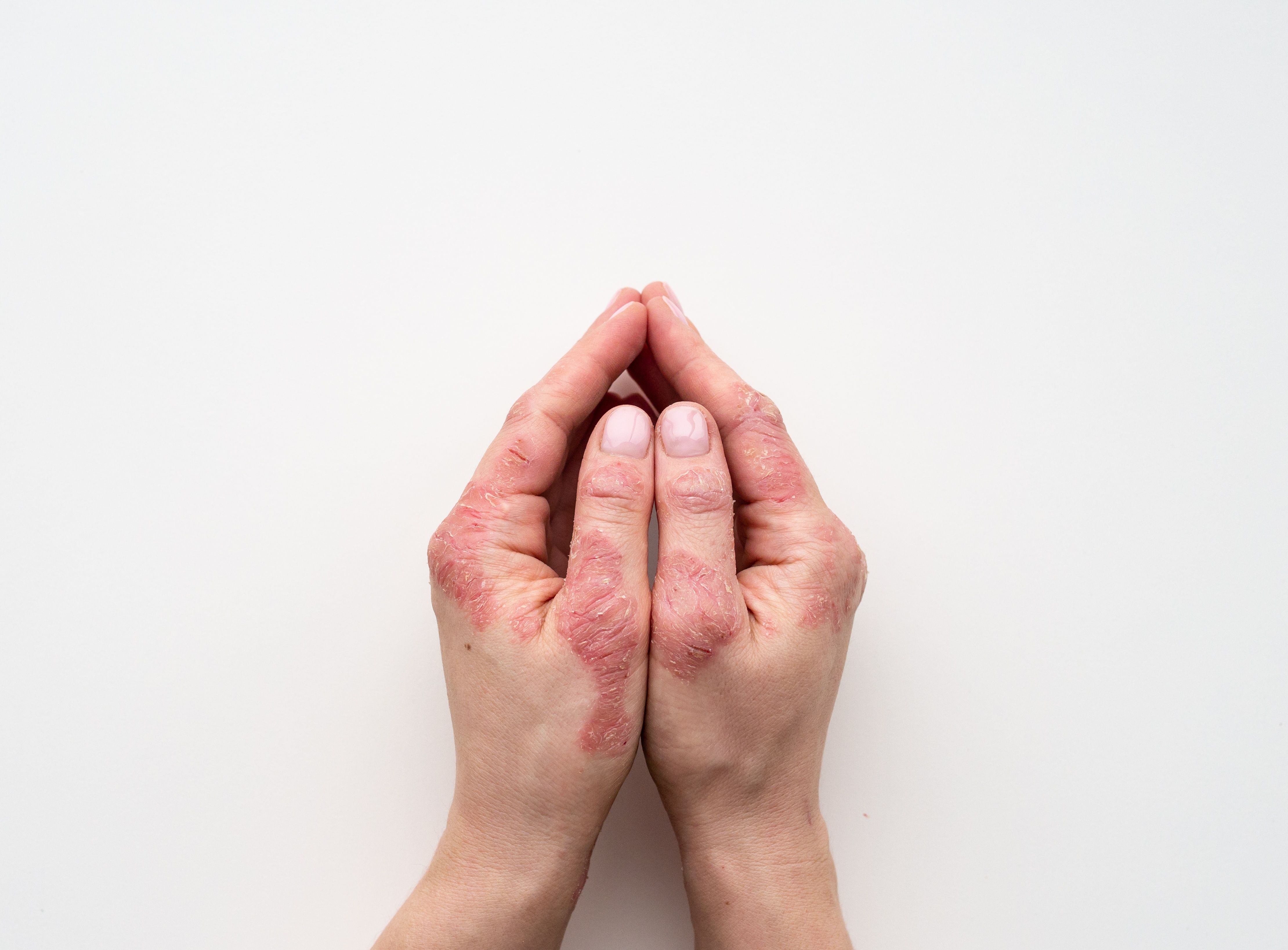 Psoriasis skin. Closeup of rash and scaling on the patient's skin. The concept of chronic disease treatment. Dermatological problems | IIIRusya - stock.adobe.com