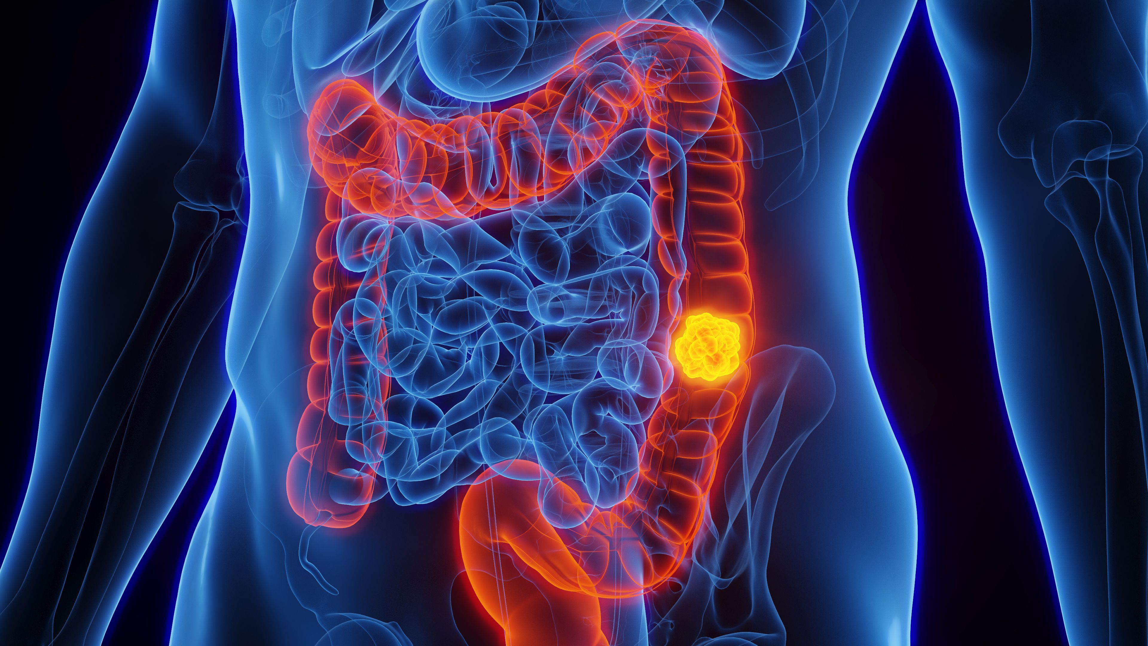 Colorectal cancer | Image credit: Sebastian Kaulitzki - stock.adobe.com