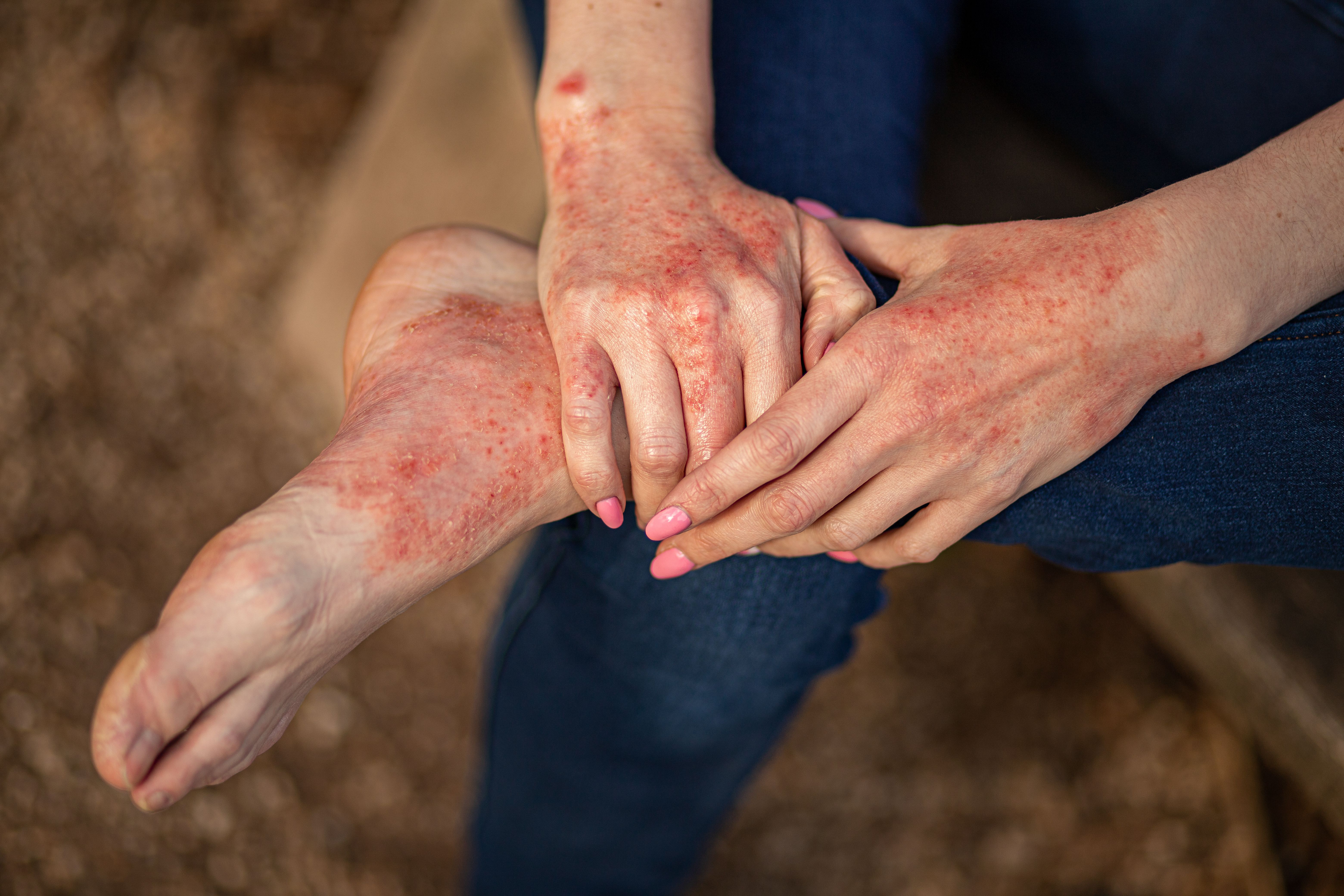 Eczema. | Image Credit: InfiniteStudio - stock.adobe.com