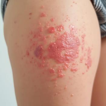 Urticaria. | Image Credit: teambdcx - stock.adobe.com