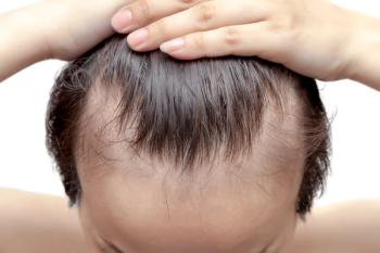 Receding hair line | Image Credit: Bongkochrut - stock.adobe.com