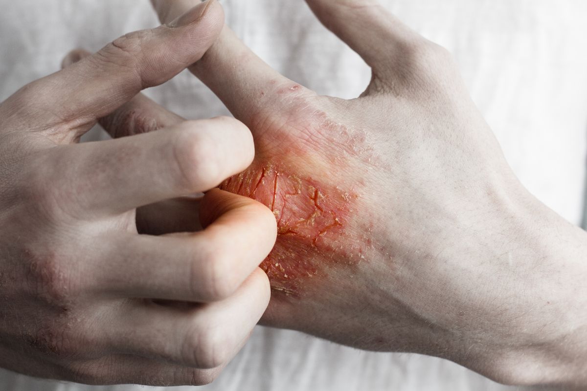 Psoriasis on hand.