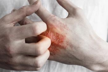 Psoriasis patch on hand.