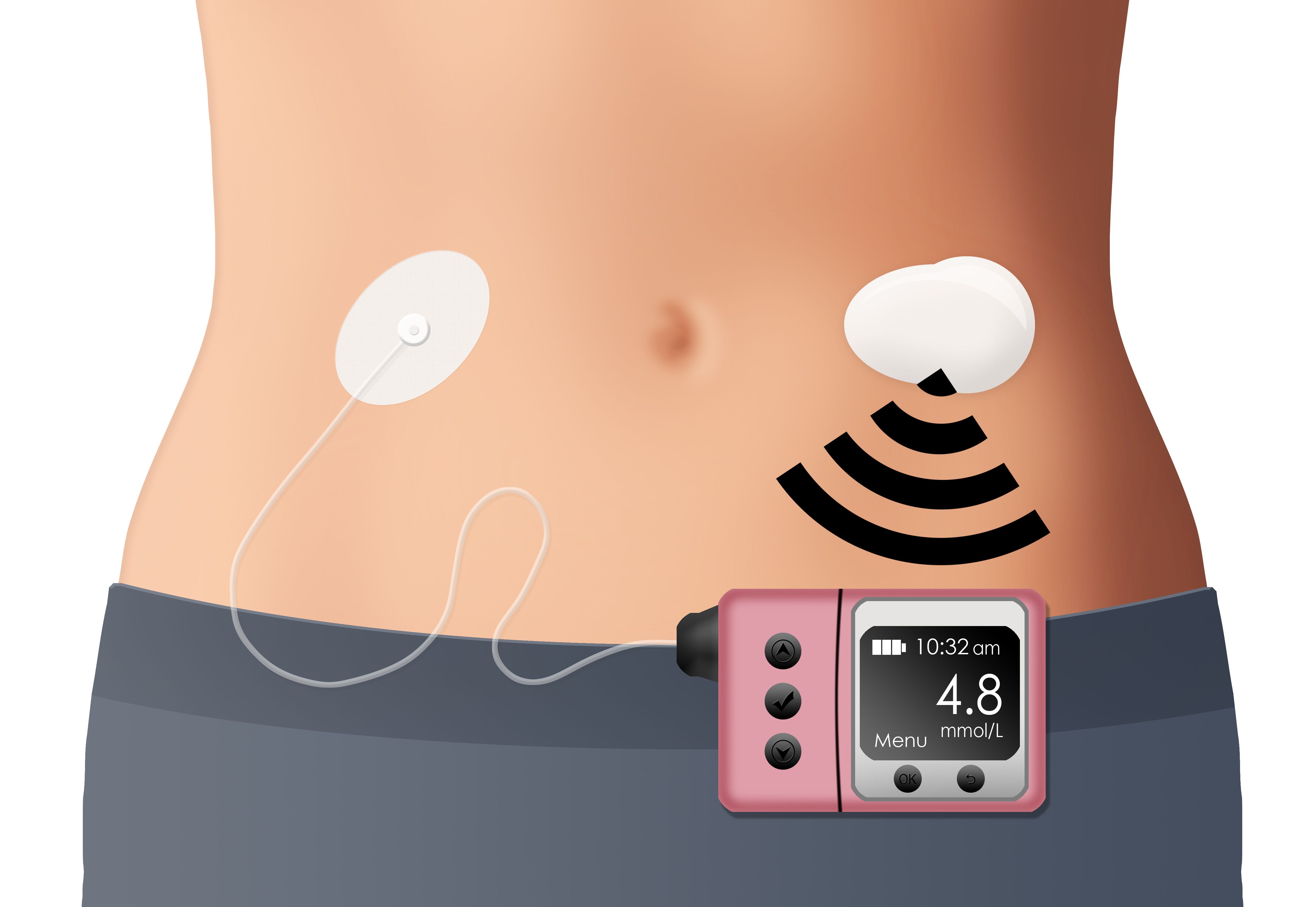 glucose monitor