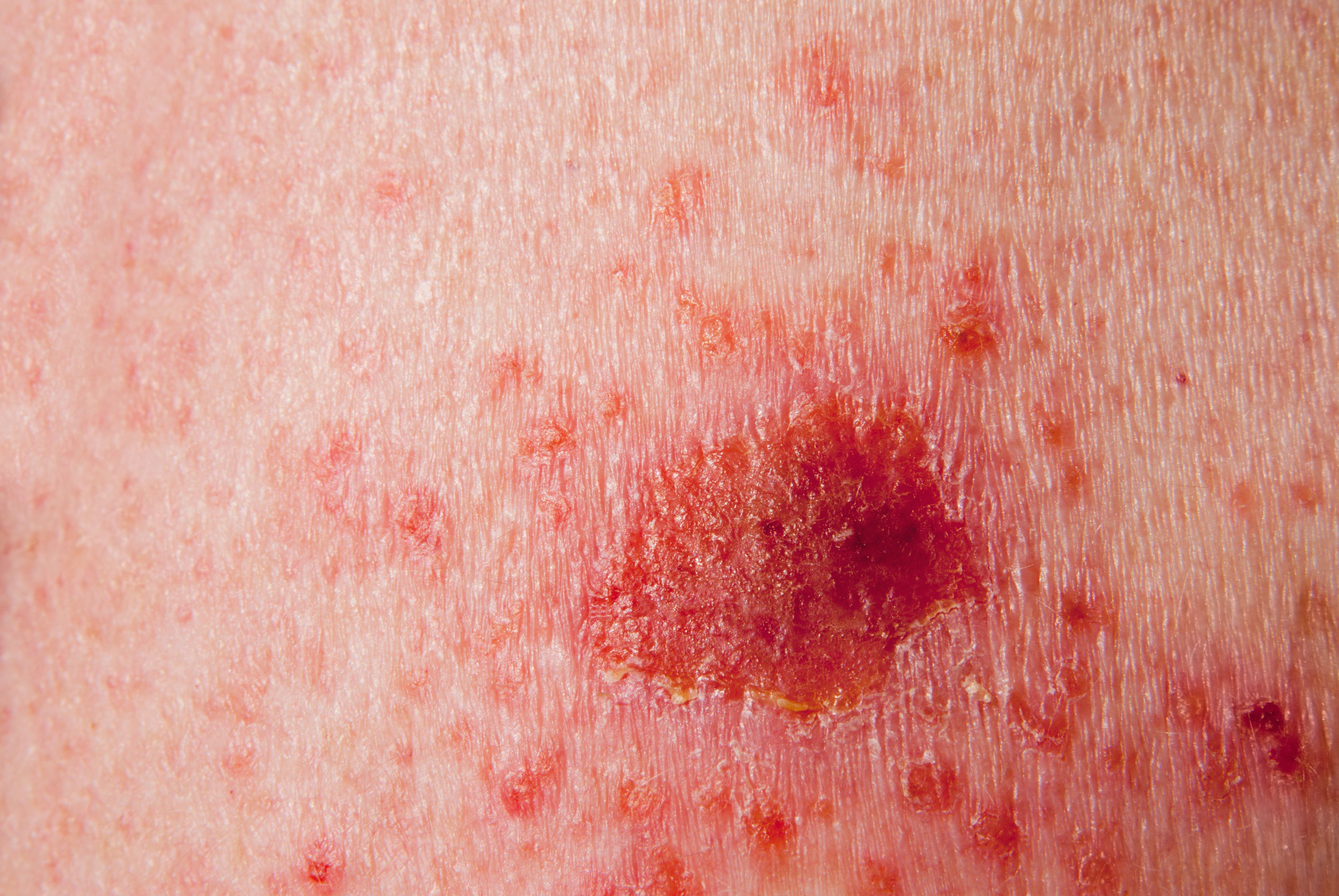 Basal Cell Carcinoma | image credit: Laura Ballard - stock.adobe.com