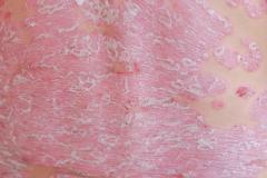 image of psoriasis