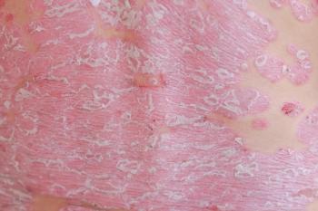image of psoriasis