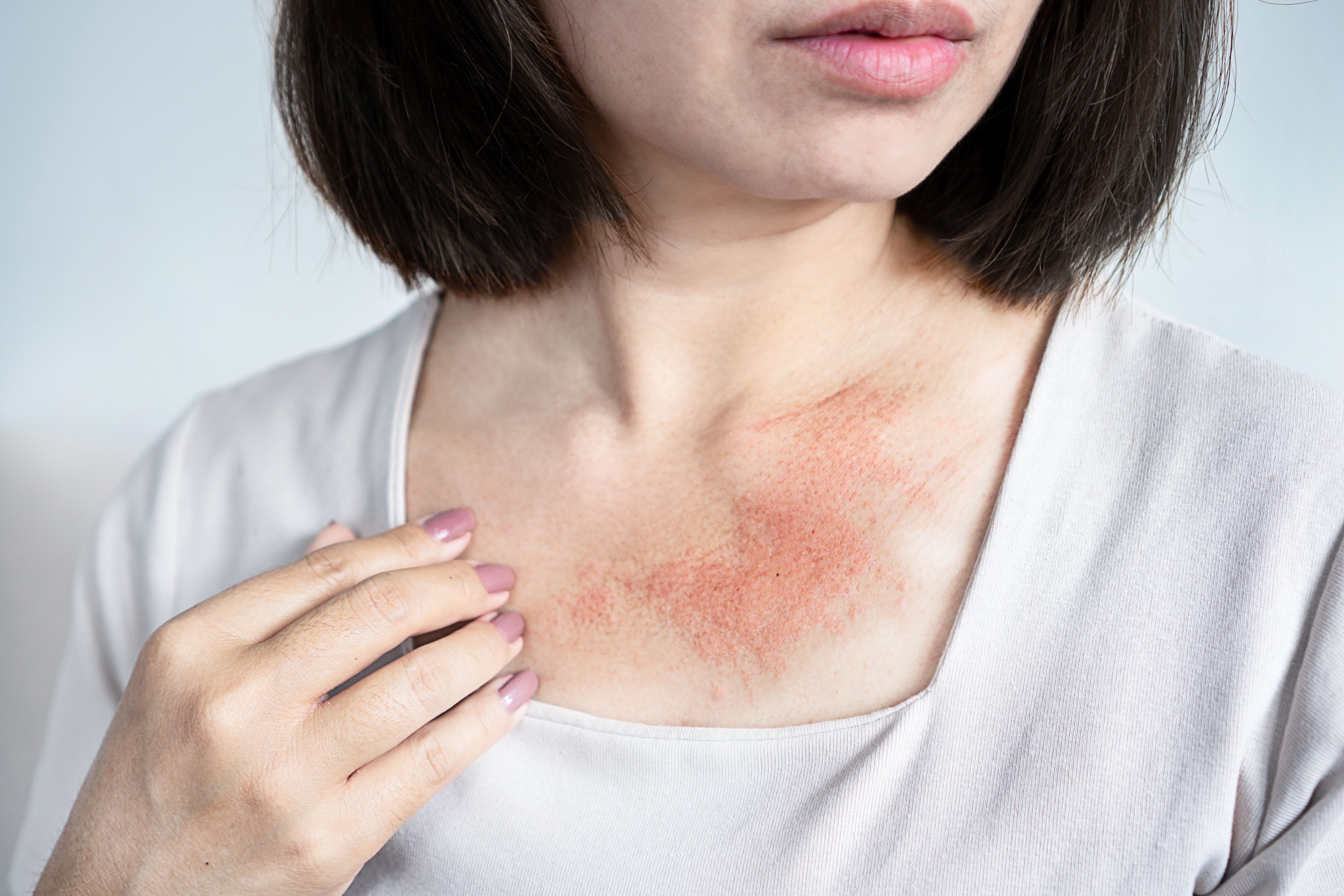 Chronic urticaria. | Image Credit: doucefleur -  stock.adobe.com 