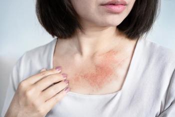 Chronic urticaria. | Image Credit: doucefleur -  stock.adobe.com 