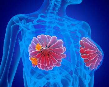 Representation of breast cancer | Image Credit: Giovanni Cancemi - stock.adobe.com
