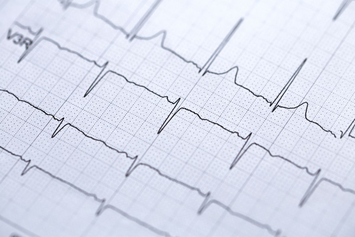 Image of ECG