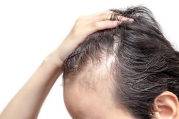 Receding hairline | Image Credit: Bongkochrut - stock.adobe.com